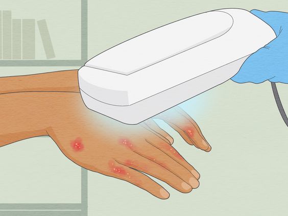 Dyshidrotic Eczema, Dyshidrosis: Symptoms, Causes, Treatments